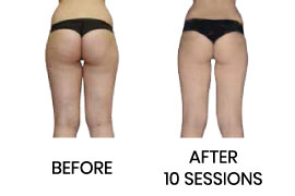 Cellulite Smoothed